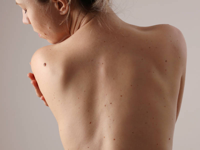 Un livre pour mieux comprendre les difficultés de s’habiller avec un syndrome d’Ehlers-Danlos